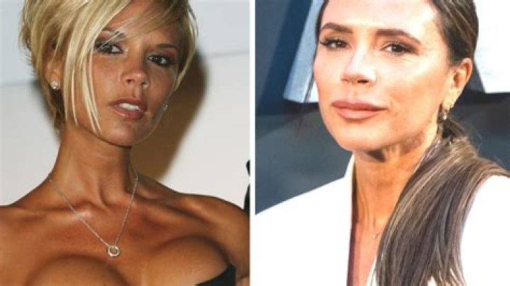 Victoria Beckham Reveals What Plastic Surgery She’s Had: Her Transformation in Photos